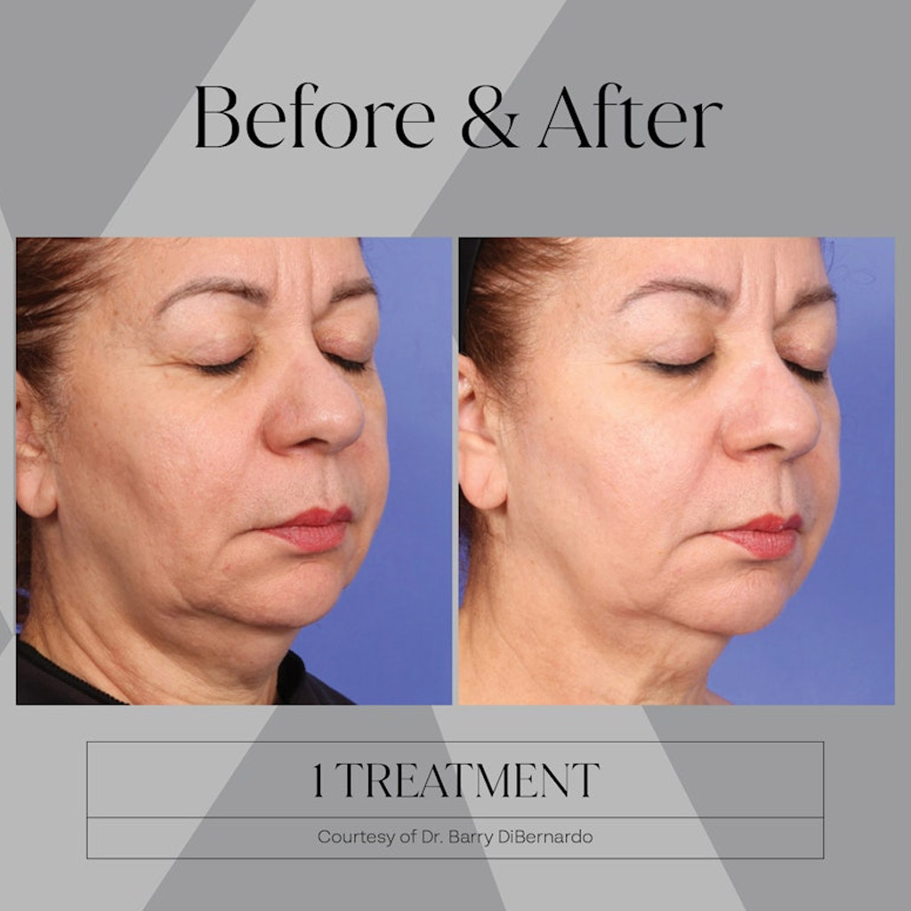 before-after-n1