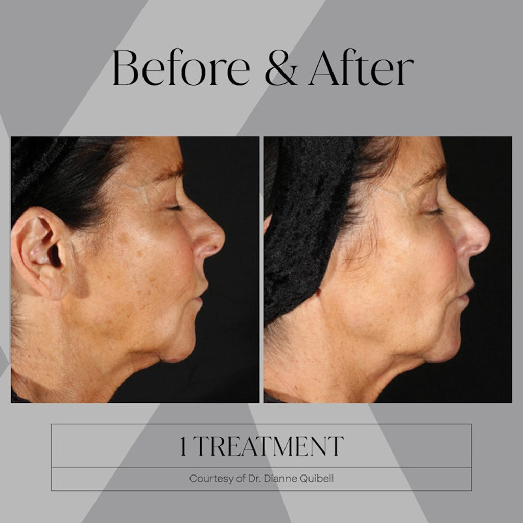 before-after-n2