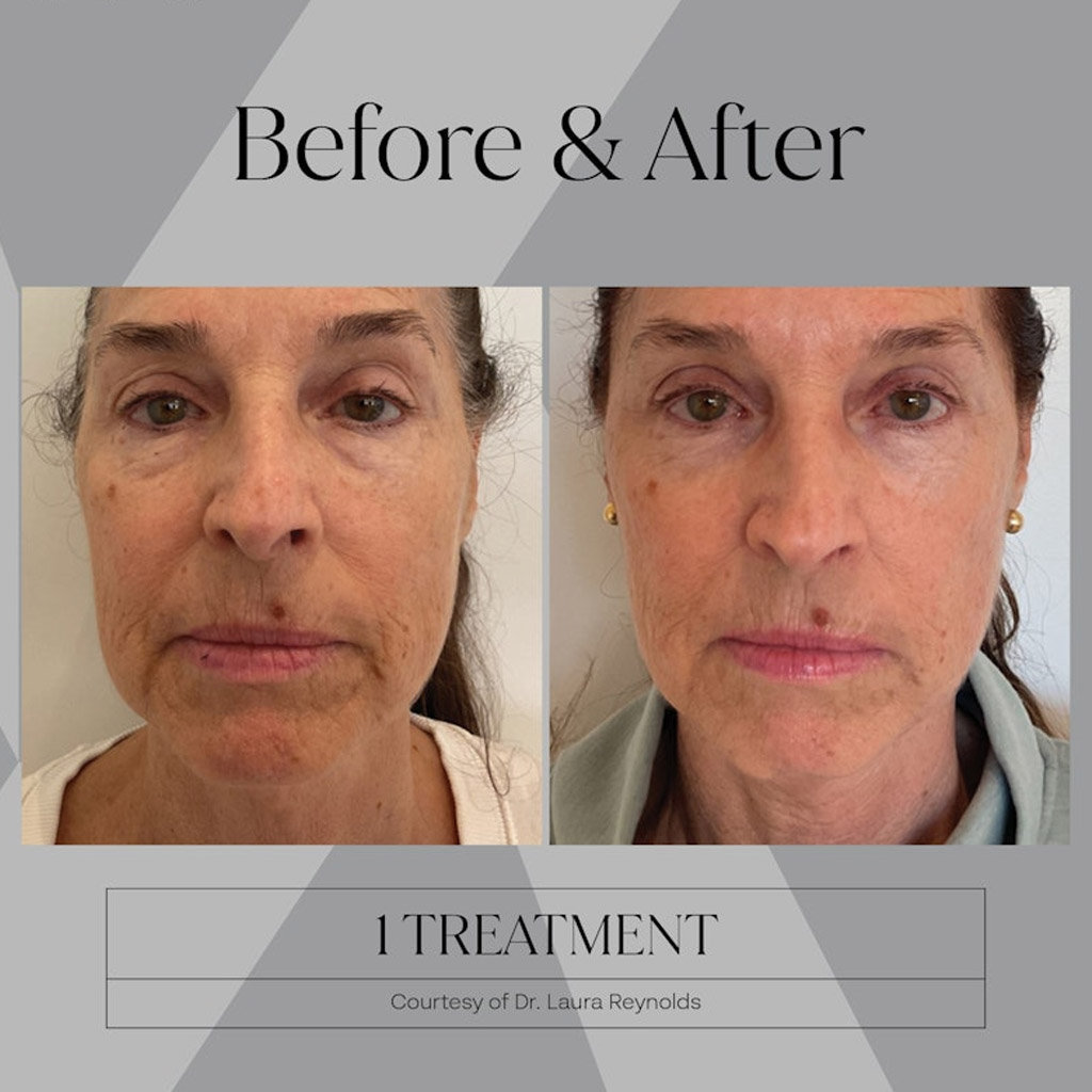before-after-n3