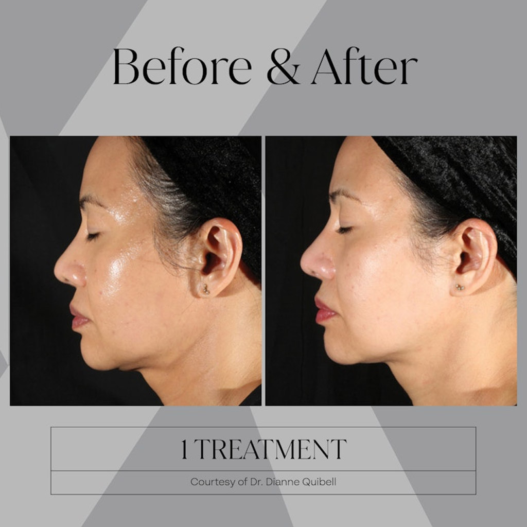 before-after-n4