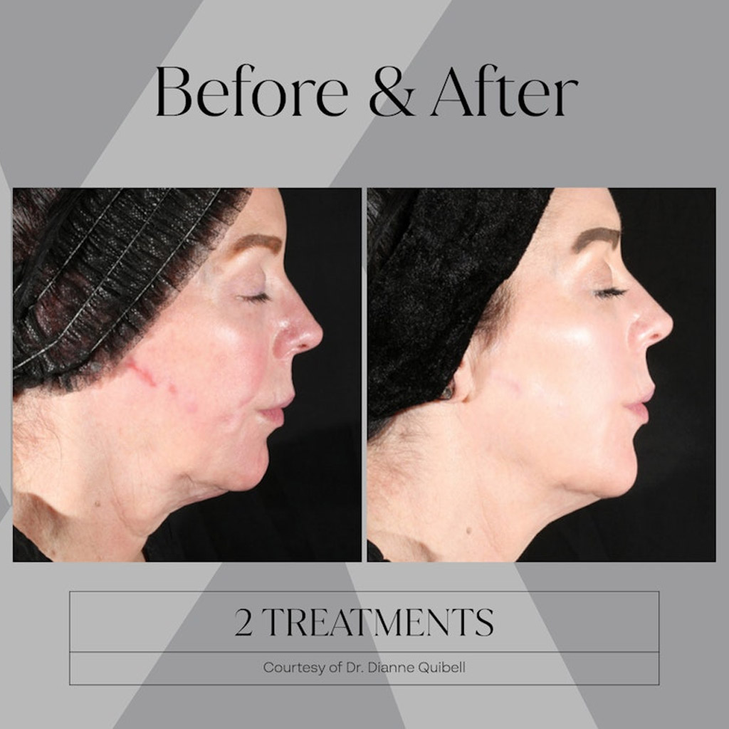 before-after-n5